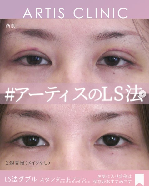 アーティスクリニックの症例写真 LS法ダブル (ロングプラン)＋他院抜糸