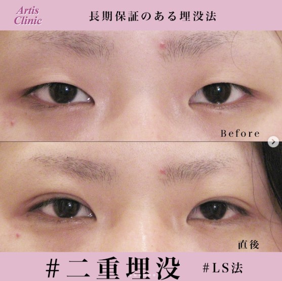 アーティスクリニックの症例写真 LS法シングル (ロングプラン)