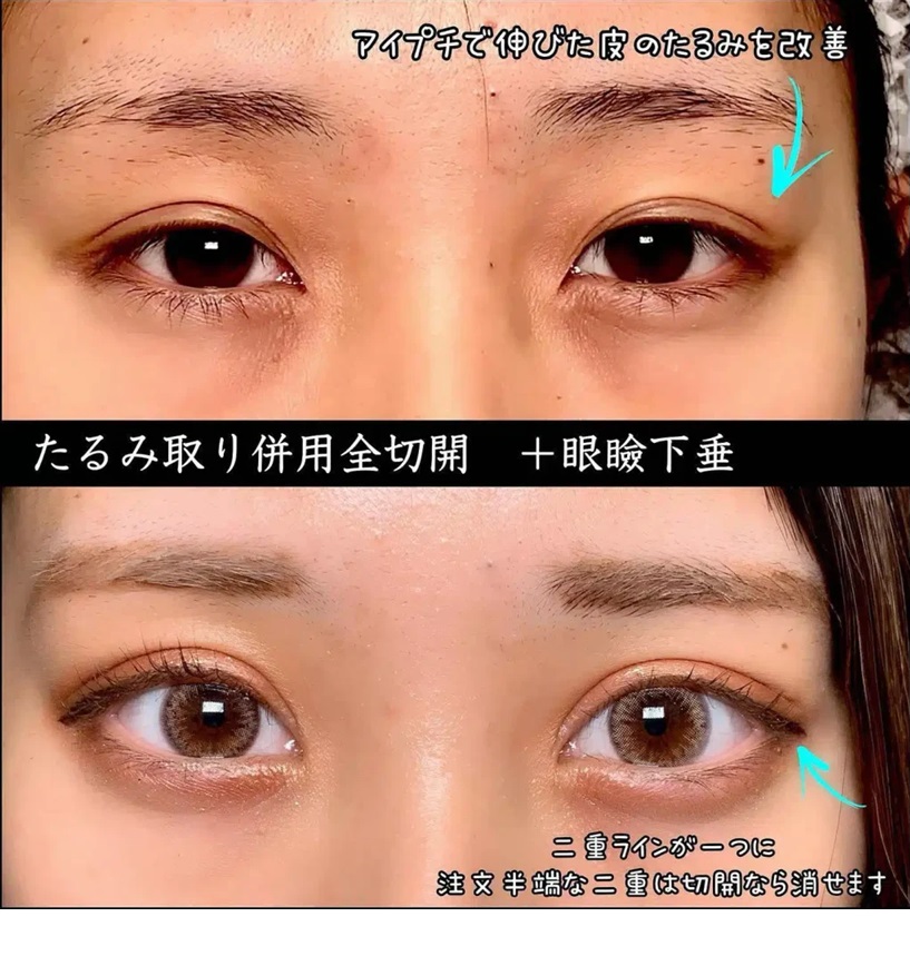 eclinic(イークリニック) 福岡院の症例写真 たるみ取り併用全切開＋眼瞼下垂